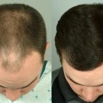 Метод пересадки волос FUT: искусство восстановления естественной красоты